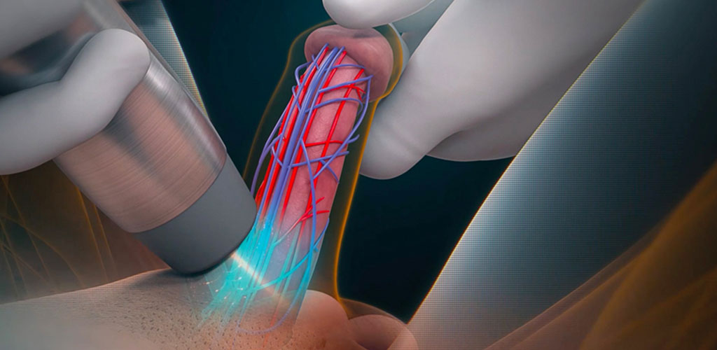 Urología - Tratamiento con ondas de choque en Impulso Médica