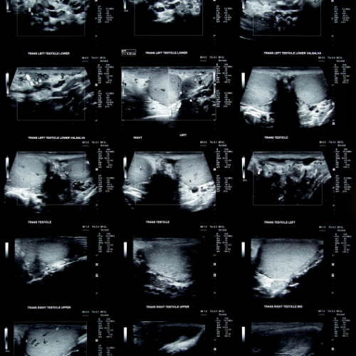 Ecografía testicular